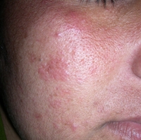 eruption light polymorphic pmle polymorphous skin ple rash sun