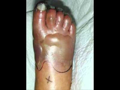 Cellulitis Pictures, Symptoms, Treatment & Complications