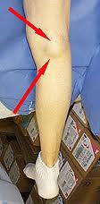 baker cyst (popliteal cyst)