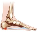 Calcaneal Spur