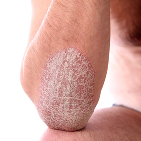 13 Photos of Plaque Psoriasis - healthline.com