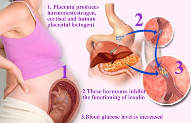 Gestational Diabetes (GDM): Causes, Symptoms, Risks And Treatment - Boldsky.com