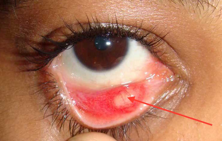 Поражение слизистой глаза при сифилисе