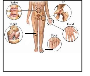 Rheumatoid Arthritis