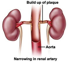 Nephrosclerosis