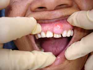 Tooth Abscess