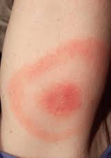 lyme disease