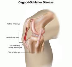 osteochondrosis