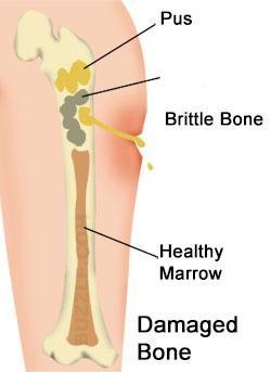 osteomyelitis