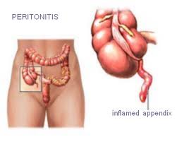 peritonitis