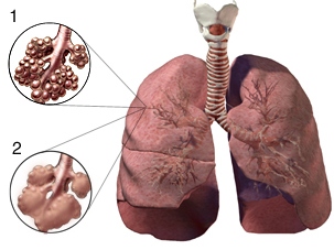 emphysema