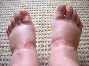 drthind_edema in feet