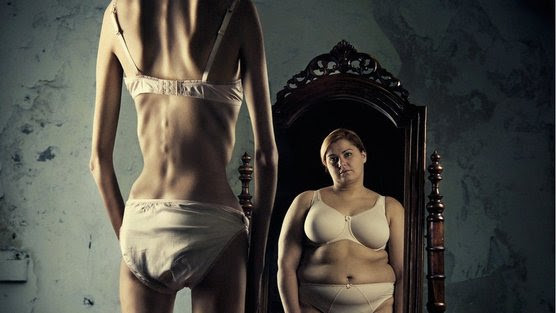 Bulimia Nervos Anorexia Nervosa