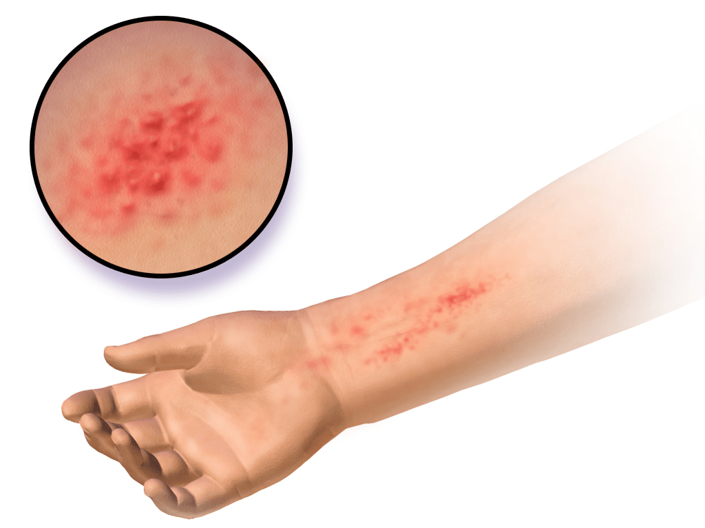 Allergic Contact Dermatitis Symptoms And Cure By Homeopathy