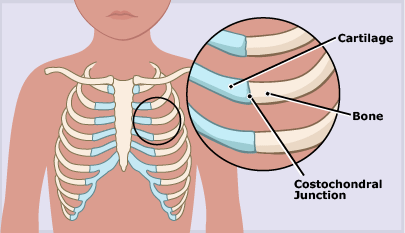 costochondritis