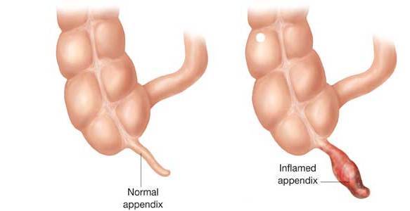 appendicitis