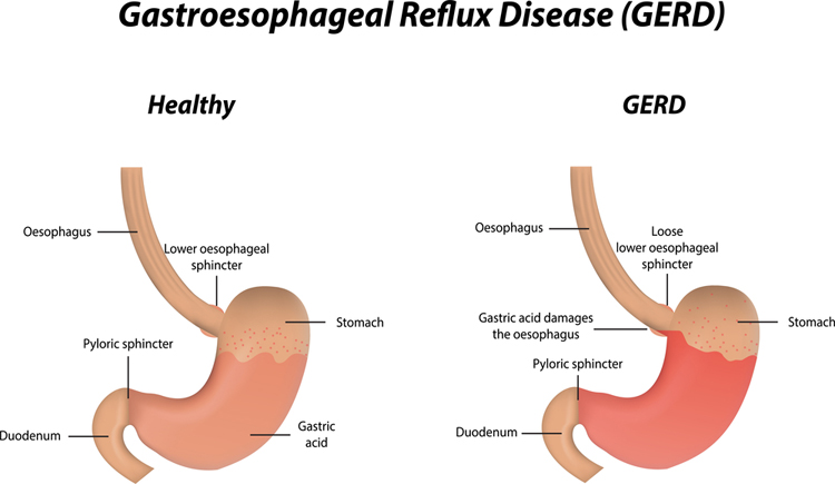 GERD gastroesophageal reflux disease