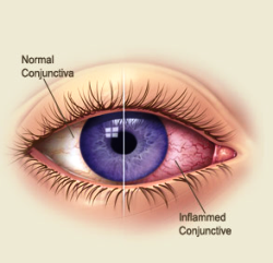 allergic conjunctivitis