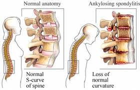 ankylosing spondylitis