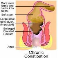 chronic Constipation