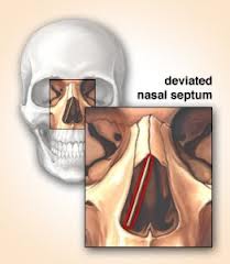 deviated nasal septum