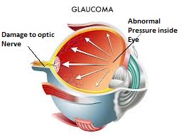 glaucoma