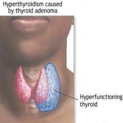 Hyperthyroidism