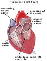 Hypoplastic syndrome