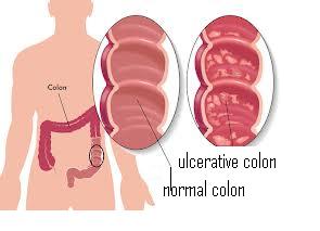 ulcerative colitis