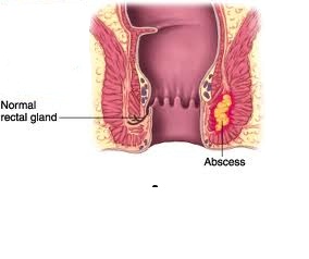 anal abscess