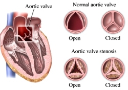 aortic stenosis