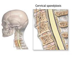 cervical spondylosis