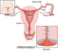 cervicitis