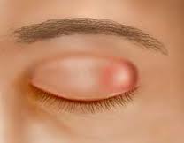 chalazion