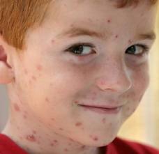 chicken pox