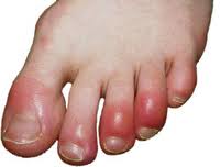 chilblains