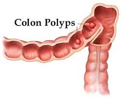 colon polyp