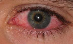 conjunctivitis