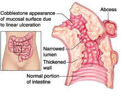 crohn disease