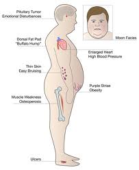 cushing syndrome