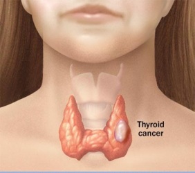 anaplastic thyroid carcinoma