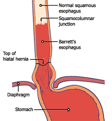 barrett syndrome