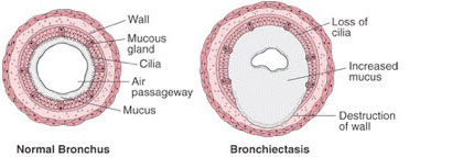 bronchiectasis