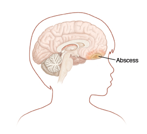 cerebral abscess