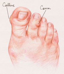 corns and callus