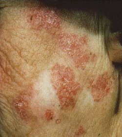 discoid lupus erythematosus