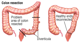 diverticulitis