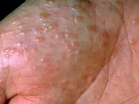 dyshidrotic eczema