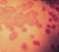 erythema multiforme