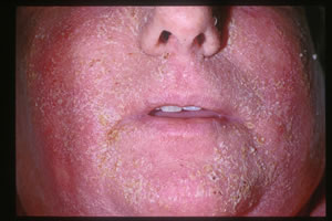 exfoliative dermatitis